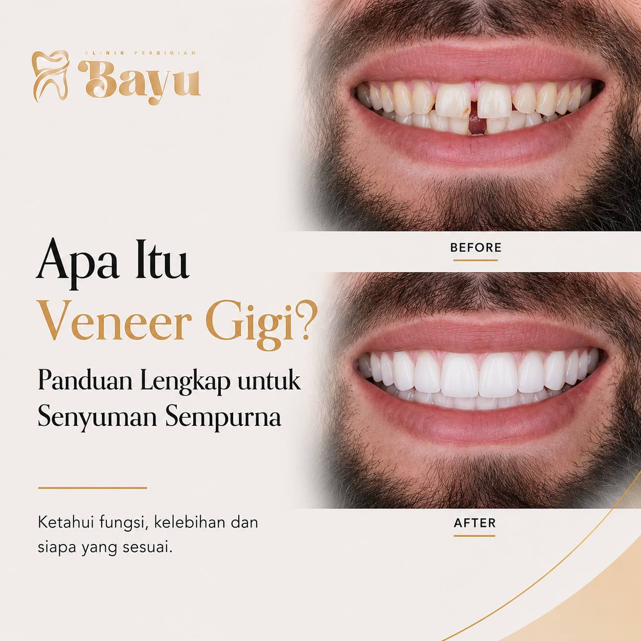 Apa Itu Veneer Gigi? Panduan Lengkap untuk Senyuman Sempurna